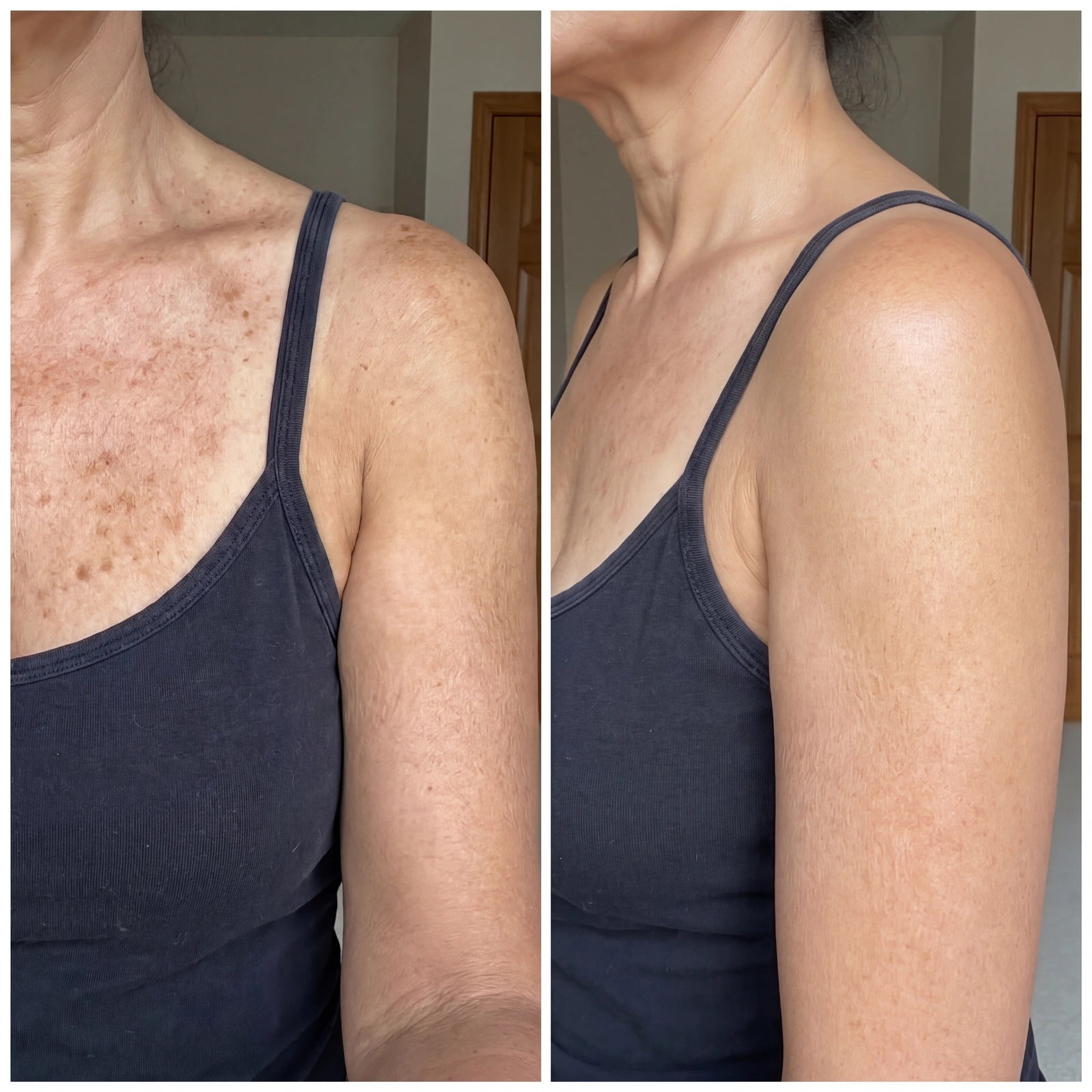 Side-by-side photos of the neck, chest and upper arm supplied by After 8